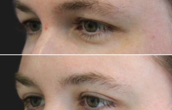 Awake Upper Eyelid Lift – before and 5 months after on a 39-year-old patient, showing a natural and masculine refreshed eye appearance with more visible upper eyelids and a brighter, more alert look.