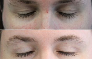 Awake Upper Eyelid Lift – before and 5 months after on a 39-year-old patient, showing a natural and masculine refreshed eye appearance with more visible upper eyelids and a brighter, more alert look.
