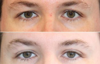 Awake Upper Eyelid Lift – before and 5 months after on a 39-year-old patient, showing a natural and masculine refreshed eye appearance with more visible upper eyelids and a brighter, more alert look.