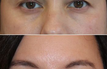 Before and 2 months after awake upper eyelid lift on a 49-year-old patient, showing a brighter, more refreshed eye area with a natural look.