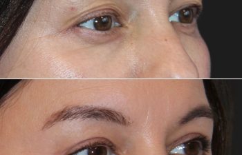 Before and 2 months after awake upper eyelid lift on a 49-year-old patient, showing a brighter, more refreshed eye area with a natural look.