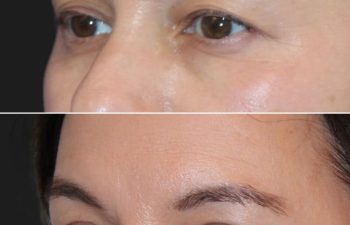 Before and 2 months after awake upper eyelid lift on a 49-year-old patient, showing a brighter, more refreshed eye area with a natural look.