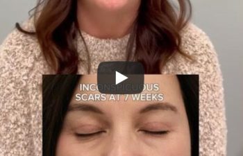 Before and 2 months after awake upper eyelid lift on a 49-year-old patient, showing a brighter, more refreshed eye area with a natural look. Includes video testimonial of the patient’s experience.