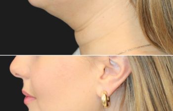 Before and 2 weeks after awake neck liposuction on a 32-year-old patient, showing a defined jawline and reduced fullness in the chin and neck area with immediate, noticeable results.