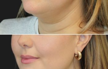 Before and 2 weeks after awake neck liposuction on a 32-year-old patient, showing a defined jawline and reduced fullness in the chin and neck area with immediate, noticeable results.