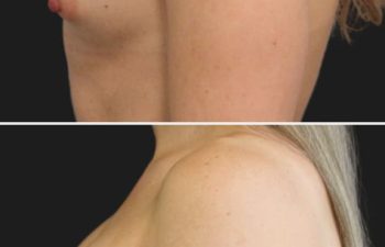 Side-by-side comparison of a person's chest before (top) and 3 months after (bottom) breast augmentation surgery with 300cc Moderate Plus implants, showing a natural, proportionate enhancement that beautifully complements her frame.