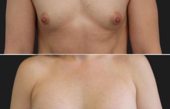 Side-by-side comparison of a person's chest before (top) and 3 months after (bottom) breast augmentation surgery with 300cc Moderate Plus implants, showing a natural, proportionate enhancement that beautifully complements her frame.
