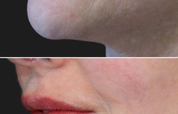 Side-by-side close-up of a 51-year-old woman's lower face before and immediately after lip filler treatment by Nurse Practitioner Kristina using 0.6ml of Revanesse Lips+, showing reduced wrinkles and fuller, plumper lips.