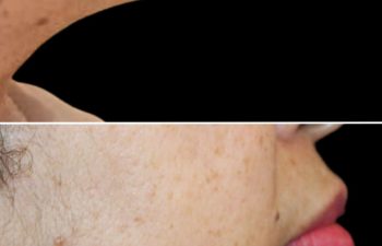 Side-by-side before and after photos of a person's chin and jawline, showing reduced sagging and improved contour in the after image.