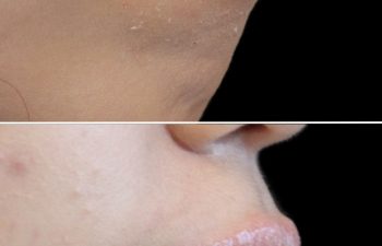 Side-by-side close-up of lower face before and after a cosmetic lip procedure; lips appear fuller and smoother in the after image.