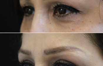 Close-up side-by-side images show a woman's eyes and eyebrows before (top) and after (bottom) a cosmetic procedure, highlighting changes in brow shape and skin texture.