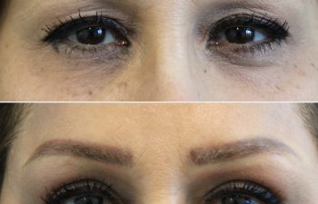 Close-up comparison of a person's eyes before (top) and after (bottom) an eyebrow cosmetic procedure, showing fuller, more defined eyebrows in the after image.