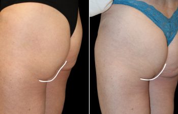 Side-by-side comparison of a woman's upper thigh and buttock area before and after a cosmetic procedure, with white lines marking changes in contour.