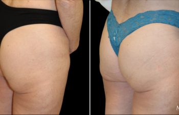 Side-by-side comparison of a woman's lower body before (left) and after (right) a cosmetic procedure, showing visible changes in skin texture and contour.