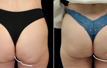 Side-by-side comparison of the lower back and buttocks of a person before and after a cosmetic procedure, showing smoother skin and reduced folds in the "after" image.