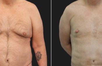 Side-by-side comparison of a person’s chest before and after a surgical procedure, showing reduced breast tissue and changes in skin appearance.