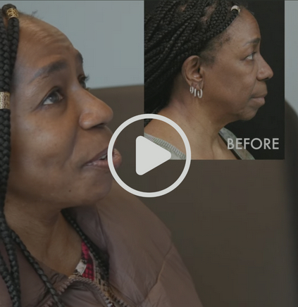 Patient 11 weeks after comprehensive facial rejuvenation, video play icon visible.