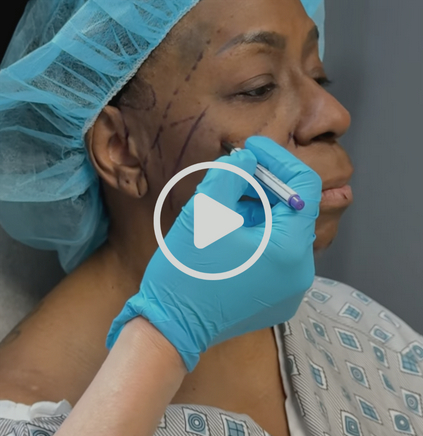 Patient being prepared for comprehensive facial rejuvenation procedure with facelift markings drawn on face, video play icon visible.