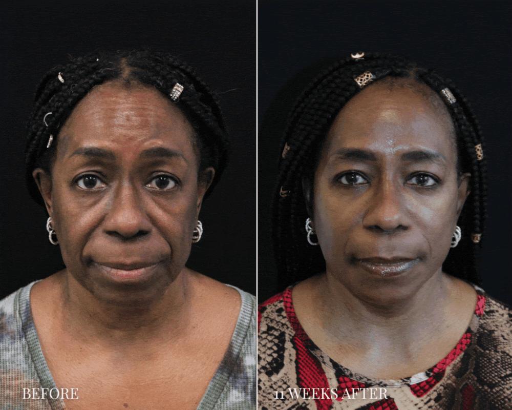 64 year old patient before and 11 weeks after comprehensive facial rejuvenation
