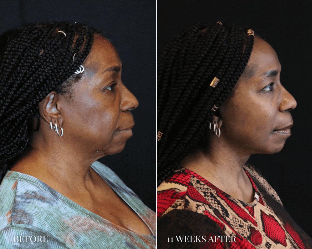 64-year-old patient before and 11 weeks after comprehensive facial rejuvenation, right side