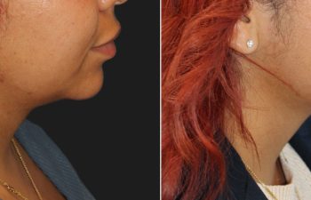 Side-by-side comparison showing a woman's jawline before and after a cosmetic procedure, highlighting a more defined chin and reduced fullness under the chin.