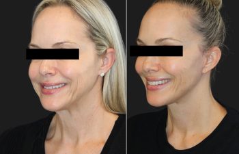 9 year-old patient before and 6 months after a facelift, neck lift, upper and lower blepharoplasty, temple lift, fat grafting, nanofat grafting, and buccal fat pad removal.