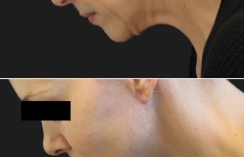 9 year-old patient before and 6 months after a facelift, neck lift, upper and lower blepharoplasty, temple lift, fat grafting, nanofat grafting, and buccal fat pad removal.