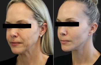 9 year-old patient before and 6 months after a facelift, neck lift, upper and lower blepharoplasty, temple lift, fat grafting, nanofat grafting, and buccal fat pad removal.