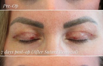 42-year-old woman before and after upper eyelid blepharoplasty: pre-op, 7 days post-op (after suture removal), and 2 months post-op without makeup
