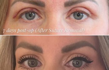 42-year-old woman before and after upper eyelid blepharoplasty: Pre-op, 7 days post-op (after suture removal), 2 weeks post-op (sent from home), and 2 months post-op (no makeup).