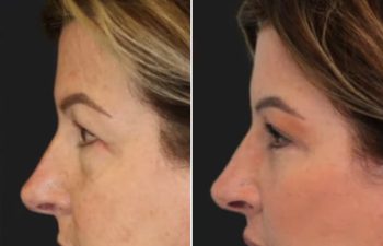 Side-by-side profile photos of a woman before (left) and after (right) a cosmetic procedure, showing smoother skin and reduced wrinkles in the after image.
