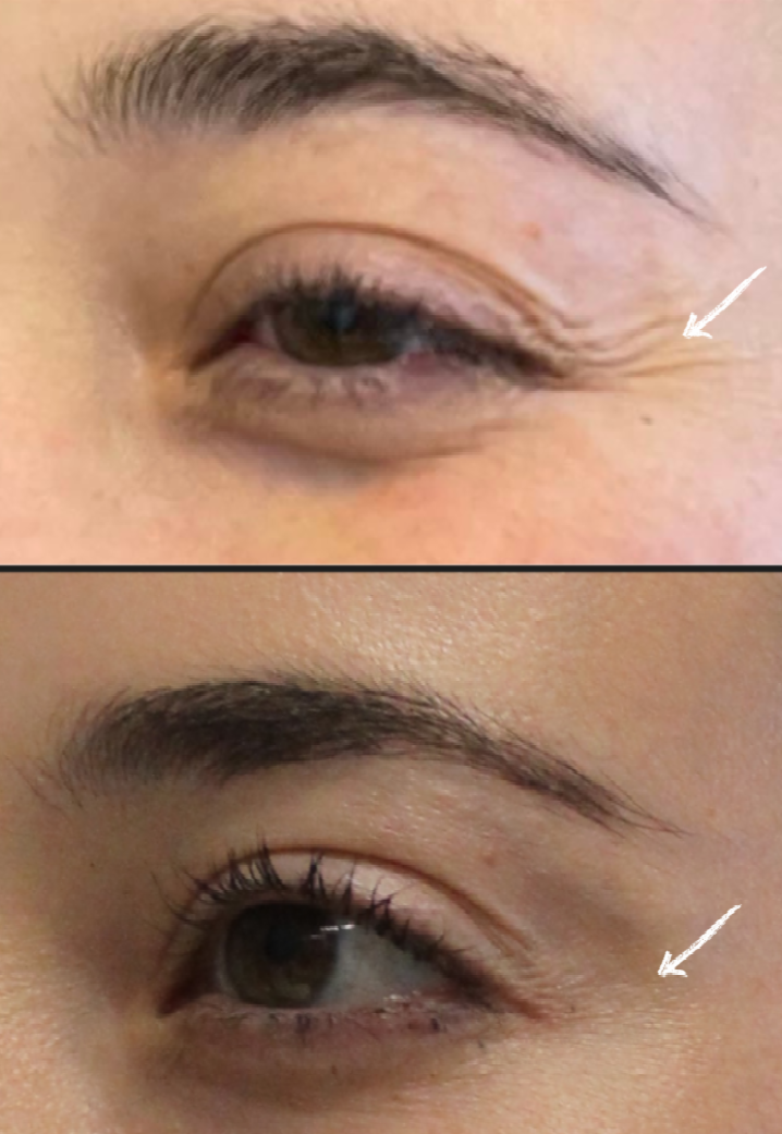 before and after wrinkle reduction at Maia Plastic Surgery