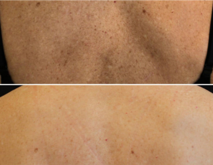 Before and After CoolPeel at Maia Plastic Surgery