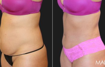 45-year-old woman before and three months after a tummy tuck and liposuction of the flanks, left oblique view.