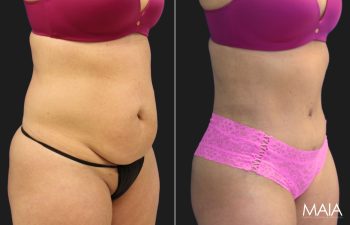 45-year-old woman before and three months after a tummy tuck and liposuction of the flanks, right oblique view.