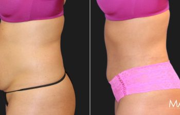 45-year-old woman before and three months after a tummy tuck and liposuction of the flanks, left view.