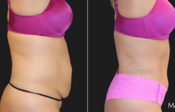 45-year-old woman before and three months after a tummy tuck and liposuction of the flanks, right view.