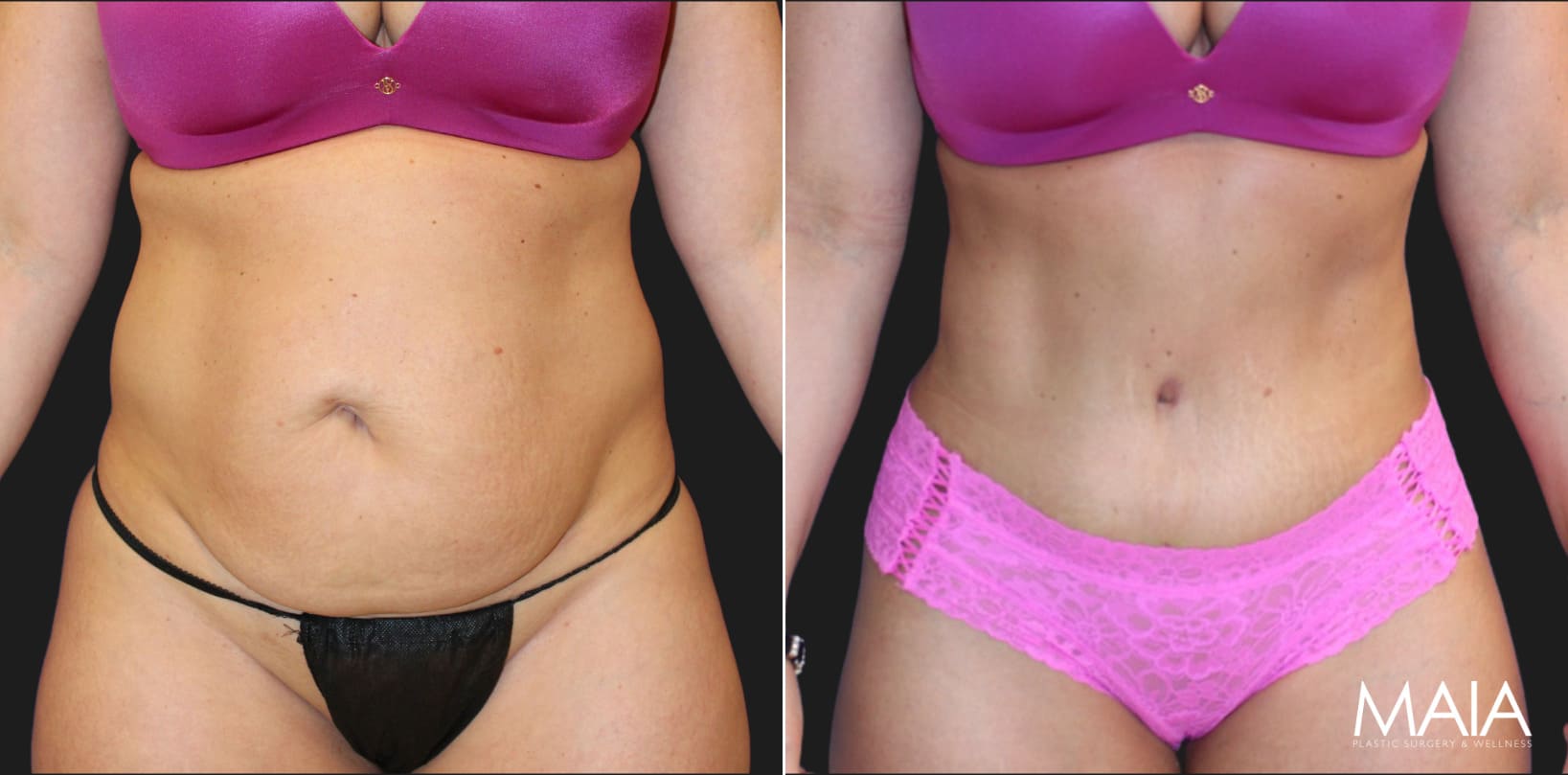 45-year-old woman before and three months after a tummy tuck and liposuction of the flanks, front view.