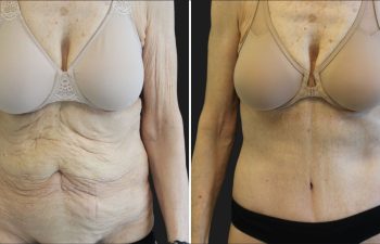 75 year-old before and 1 month after circumferential tummy tuck and arm lift