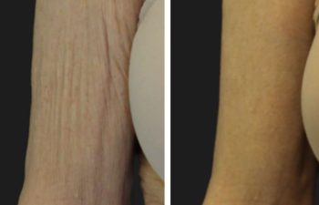 75 year-old before and 1 month after circumferential tummy tuck and arm lift