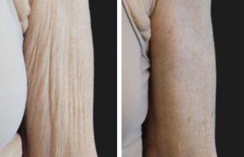 75 year-old before and 1 month after circumferential tummy tuck and arm lift
