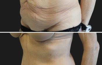 75 year-old before and 1 month after circumferential tummy tuck and arm lift
