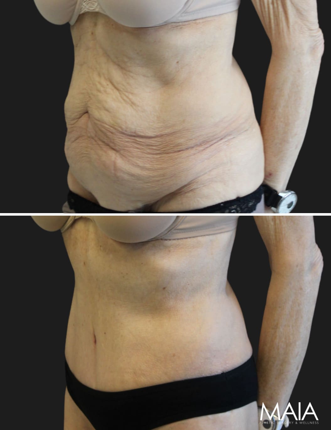 75 year-old before and 1 month after circumferential tummy tuck and arm lift