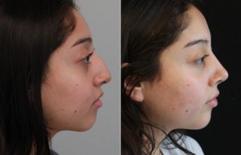 20 year old before and 5 months after rhinoplasty
