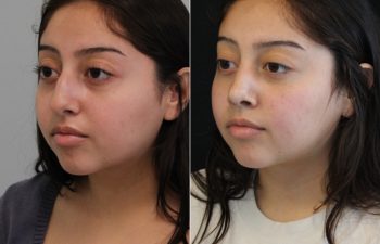 20 year old before and 5 months after rhinoplasty