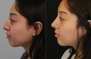 20 year old before and 5 months after rhinoplasty