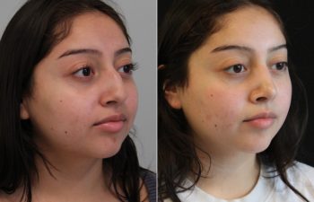 20 year old before and 5 months after rhinoplasty