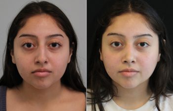 20 year old before and 5 months after rhinoplasty