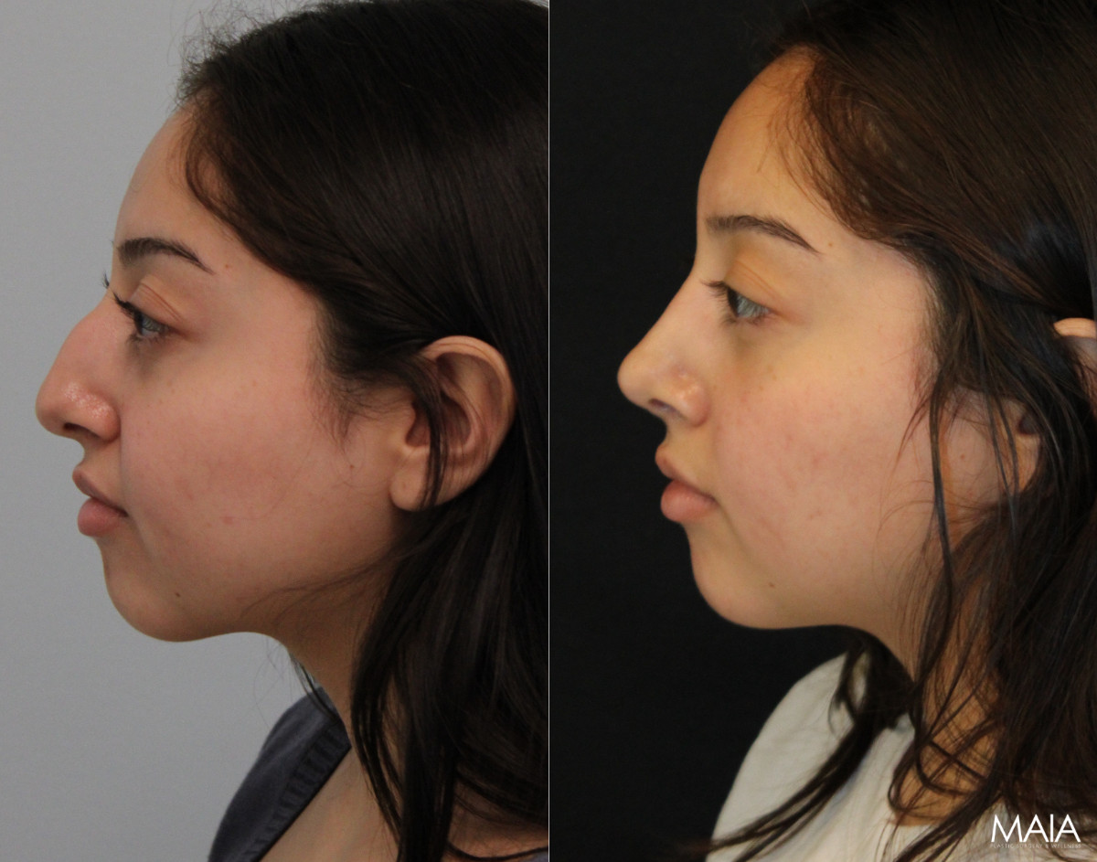 20 year old before and 5 months after rhinoplasty