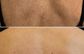 Back skin before and after two sessions of CoolPeel.